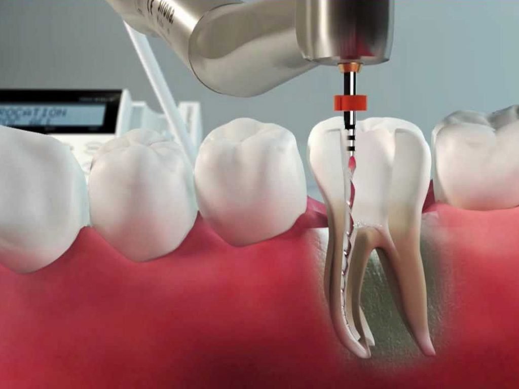 Implanto Odontologia Especializada Endodontia