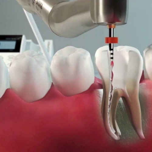 Implanto Odontologia Especializada Dentista Brasilia Tratamentos Odontologicos